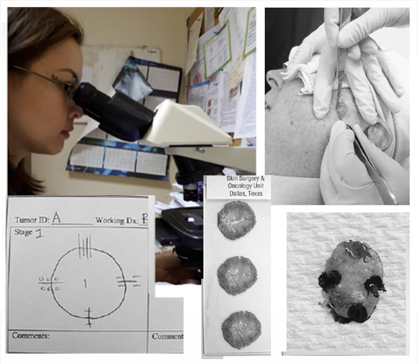 doctor looking thru a microscope, skin surgery results