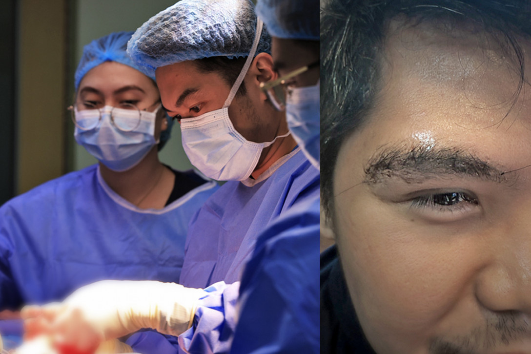 Patient’s vision restored, brain tumor removed through eyebrow surgery at The Medical City